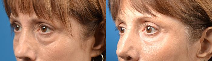 Eyelid Surgery Before & After Gallery - Patient 197452 - Image 3
