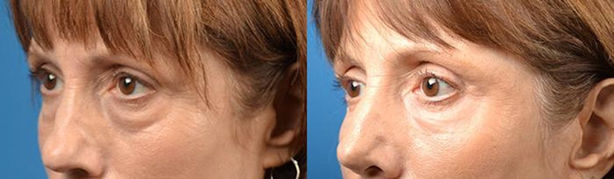 Eyelid Surgery Before & After Gallery - Patient 122406114 - Image 3
