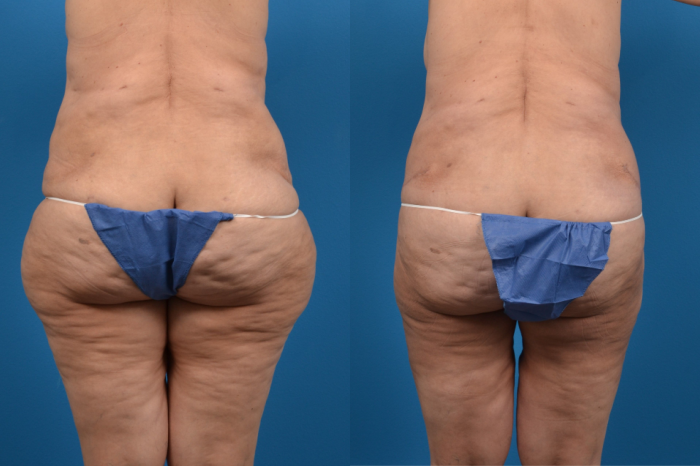 Hidden Liposuction  Before & After Gallery - Patient 332974 - Image 1