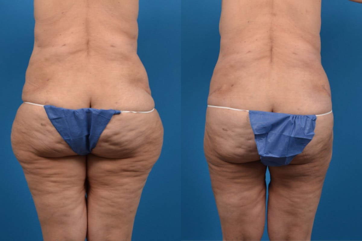 Liposuction Before & After Gallery - Patient 402796 - Image 1