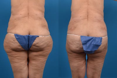 Liposuction Before & After Gallery - Patient 402796 - Image 1