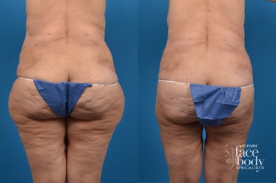 Hidden Liposuction  Before & After Gallery - Patient 332974 - Image 1