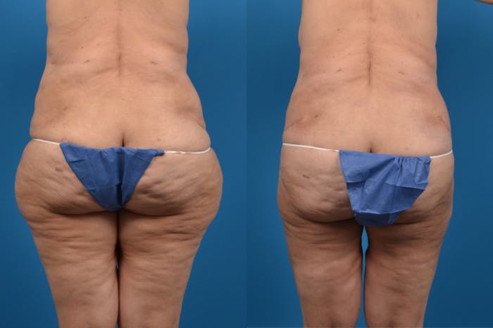 Liponique Body Contouring Before & After Gallery - Patient 122406117 - Image 1