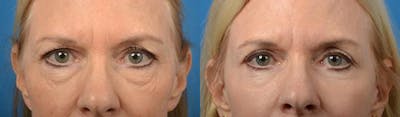 Eyelid Surgery Before & After Gallery - Patient 122406118 - Image 1