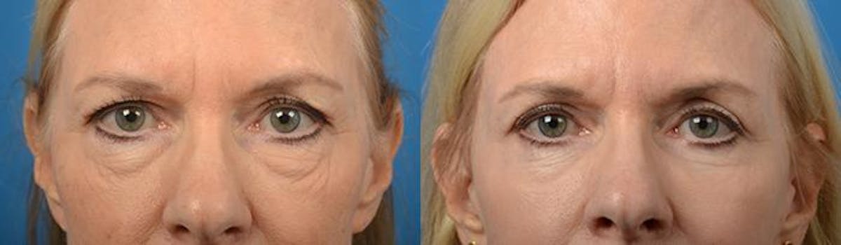 Eyelid Surgery Before & After Gallery - Patient 122406118 - Image 1