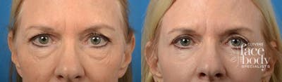Eyelid Surgery Before & After Gallery - Patient 161348 - Image 1