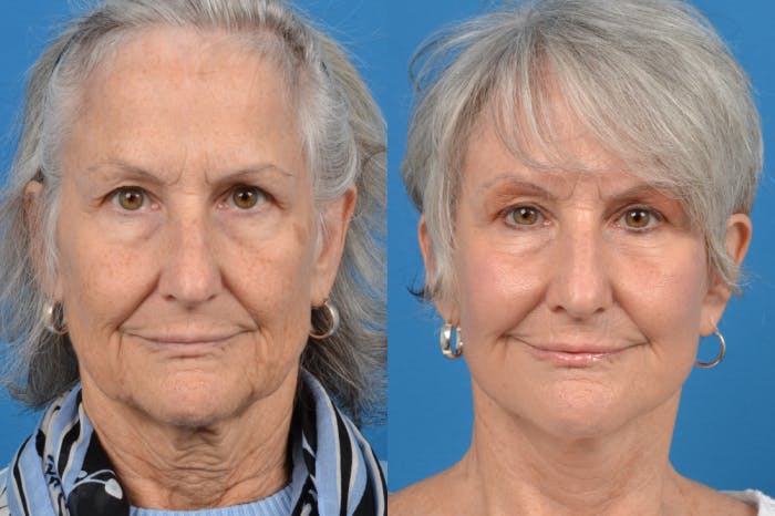 Facelift Before & After Gallery - Patient 122406120 - Image 1
