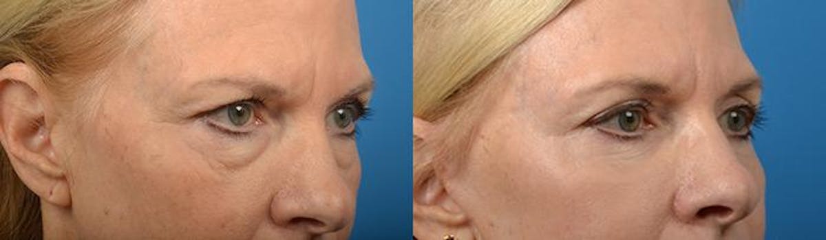 Eyelid Surgery Before & After Gallery - Patient 122406118 - Image 2