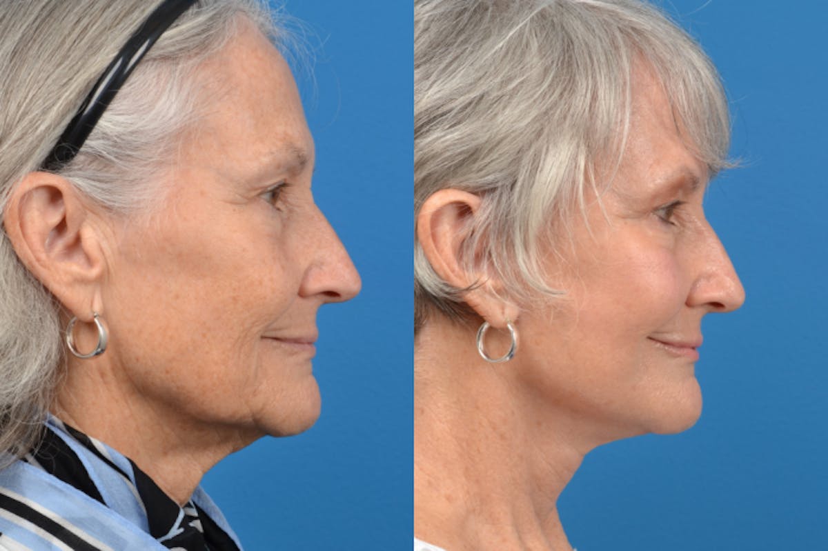 Facelift Before & After Gallery - Patient 122406120 - Image 2