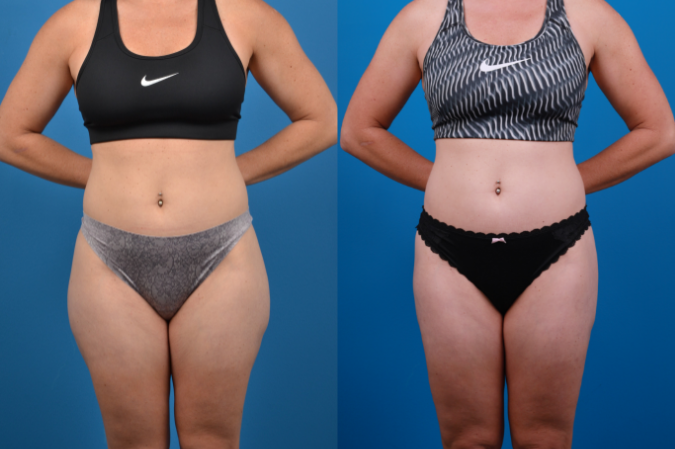 Hidden Liposuction  Before & After Gallery - Patient 141468 - Image 1