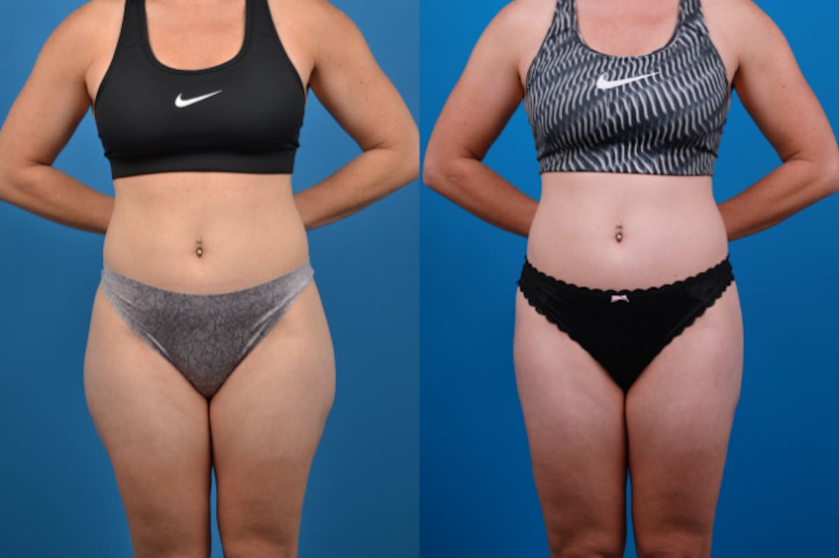 Liposuction Before & After Gallery - Patient 157490 - Image 1