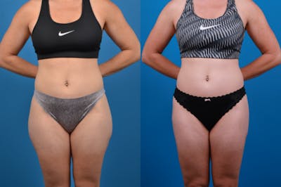 Liposuction Before & After Gallery - Patient 157490 - Image 1