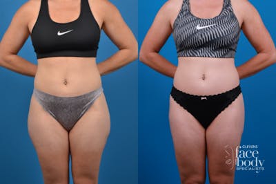Hidden Liposuction  Before & After Gallery - Patient 141468 - Image 1