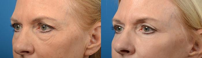 Eyelid Surgery Before & After Gallery - Patient 161348 - Image 3
