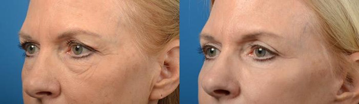 Eyelid Surgery Before & After Gallery - Patient 122406118 - Image 3