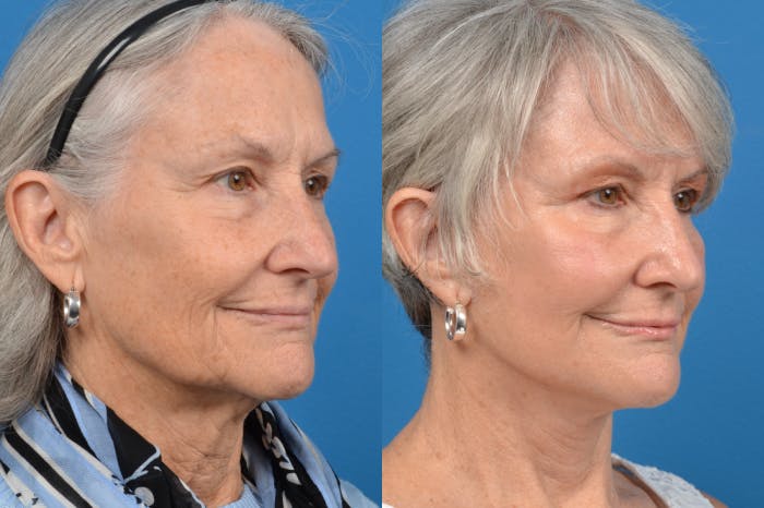 Facelift Before & After Gallery - Patient 122406120 - Image 3