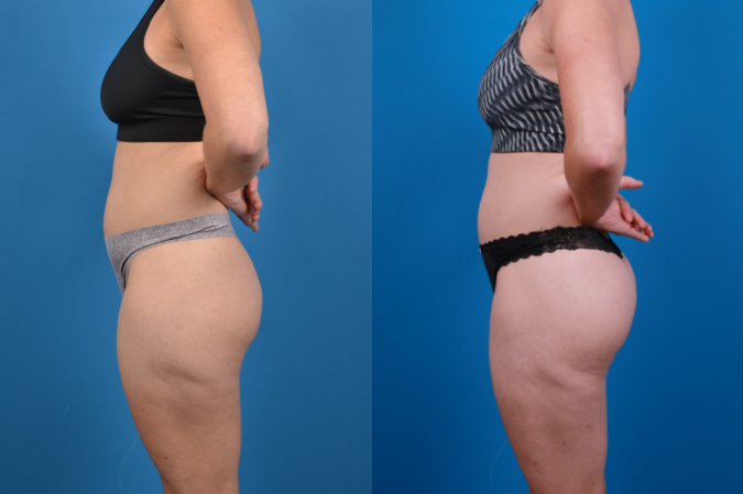 Hidden Liposuction  Before & After Gallery - Patient 141468 - Image 2