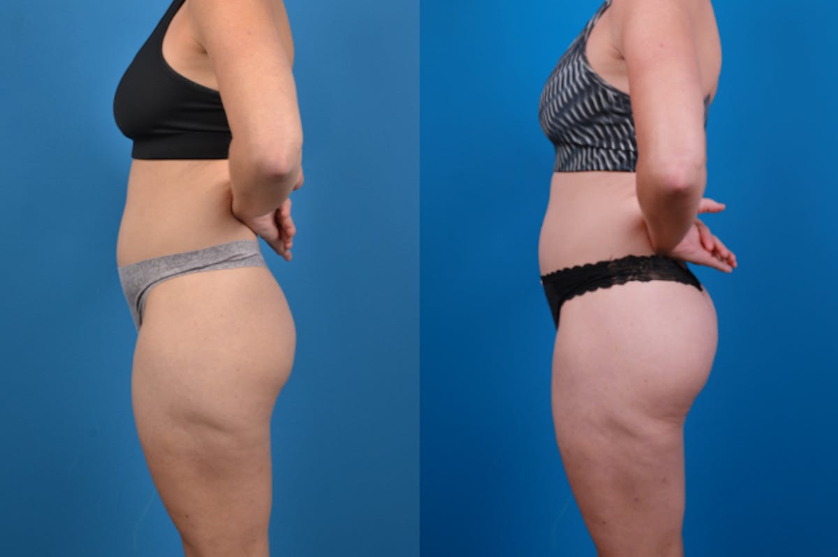 Liposuction Before & After Gallery - Patient 157490 - Image 2