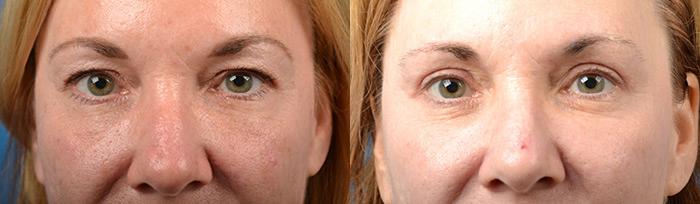Eyelid Surgery Before & After Gallery - Patient 195041 - Image 1