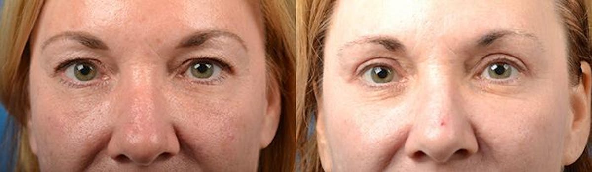 Eyelid Surgery Before & After Gallery - Patient 122406122 - Image 1