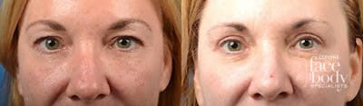 Eyelid Surgery Before & After Gallery - Patient 195041 - Image 1