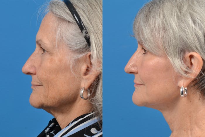 Facelift Before & After Gallery - Patient 122406120 - Image 4