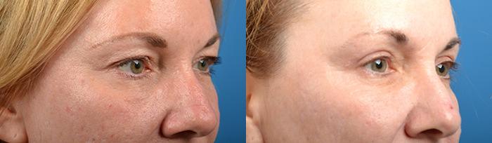 Eyelid Surgery Before & After Gallery - Patient 195041 - Image 2