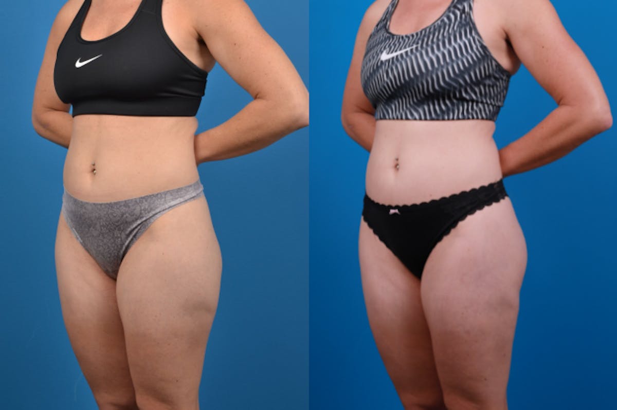 Liposuction Before & After Gallery - Patient 157490 - Image 3
