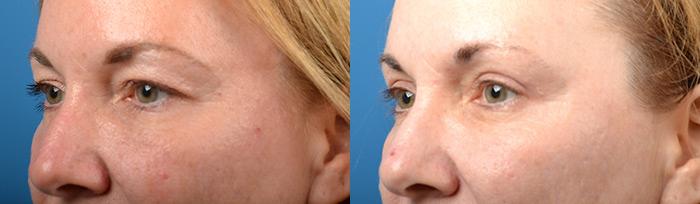 Eyelid Surgery Before & After Gallery - Patient 195041 - Image 3