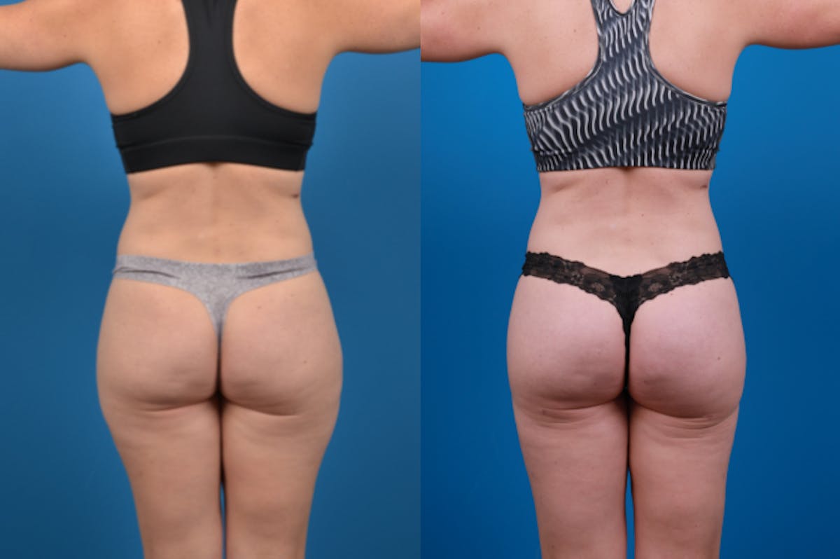 Liposuction Before & After Gallery - Patient 157490 - Image 4