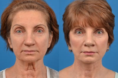 Facelift Before & After Gallery - Patient 122406126 - Image 1