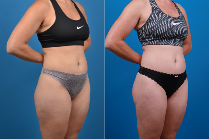 Hidden Liposuction  Before & After Gallery - Patient 141468 - Image 5