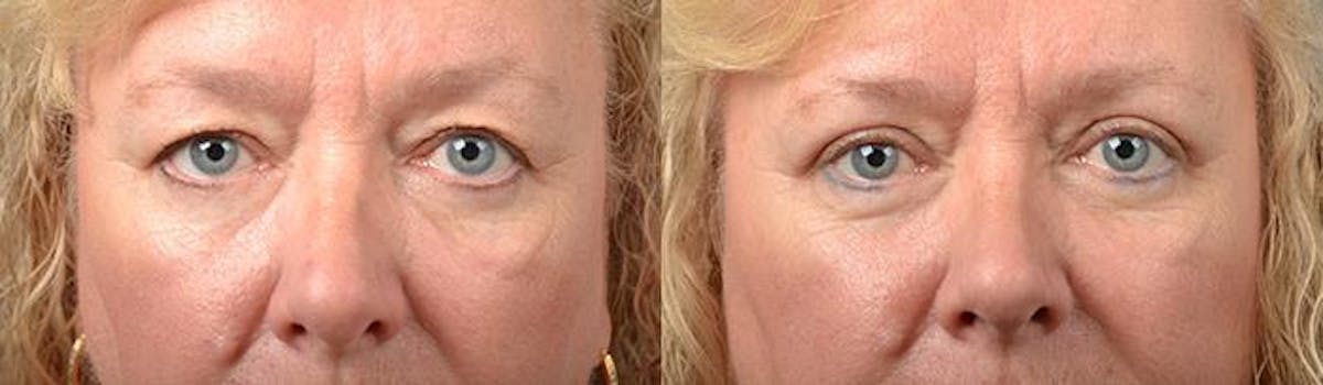 Eyelid Surgery Before & After Gallery - Patient 122406123 - Image 1