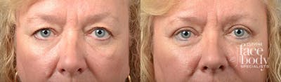 Eyelid Surgery Before & After Gallery - Patient 118231 - Image 1
