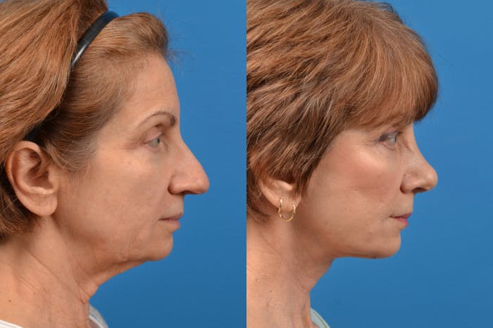 Facelift Before & After Gallery - Patient 122406126 - Image 2