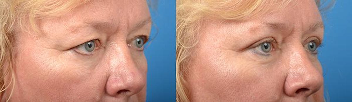 Eyelid Surgery Before & After Gallery - Patient 122406123 - Image 2