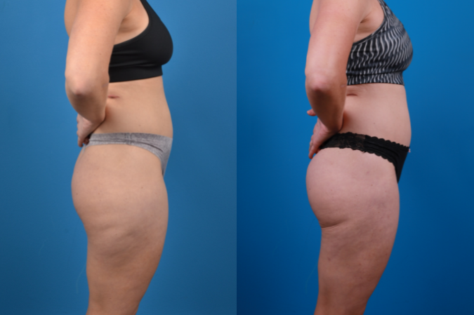 Hidden Liposuction  Before & After Gallery - Patient 141468 - Image 6