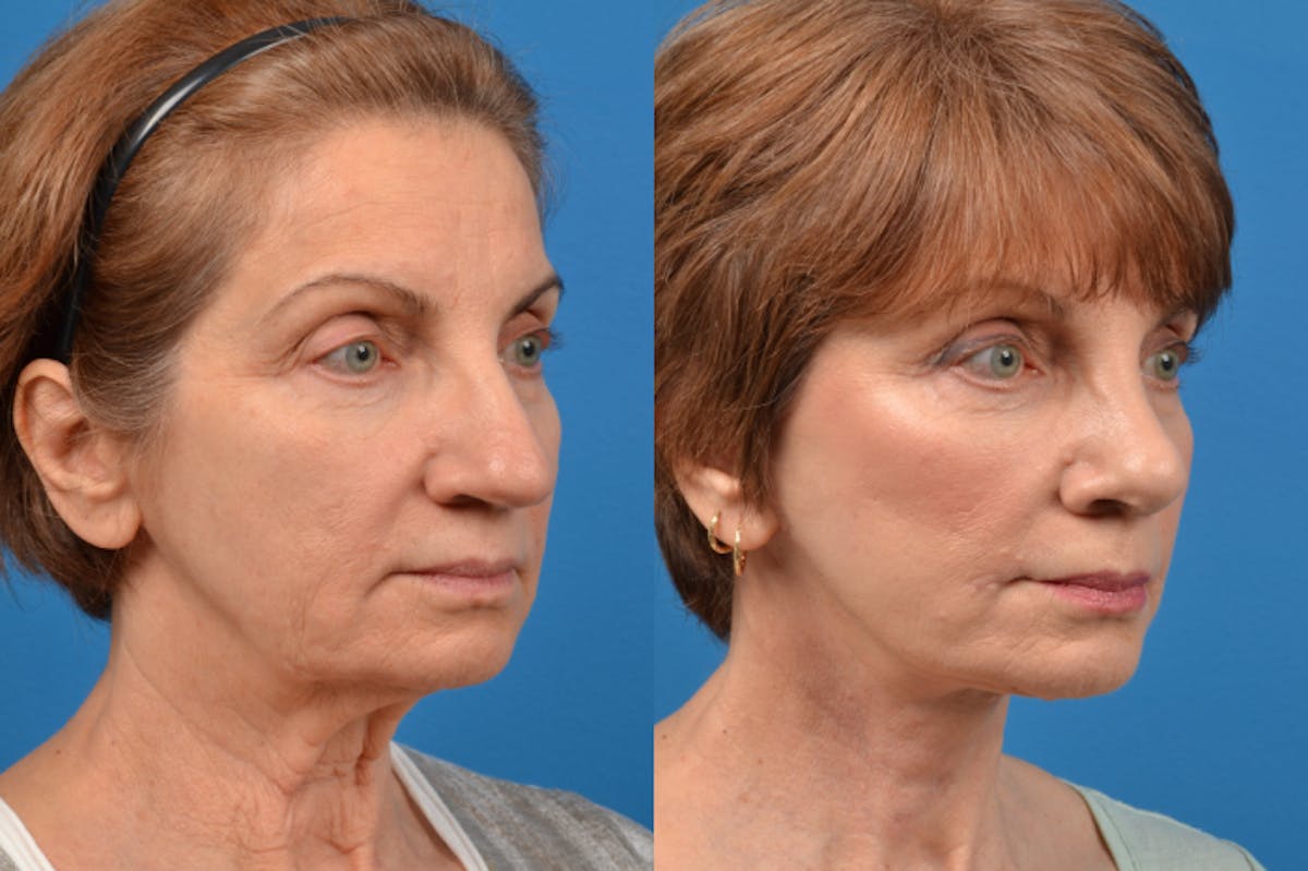 Facelift Before & After Gallery - Patient 122406126 - Image 3