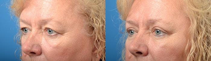 Eyelid Surgery Before & After Gallery - Patient 122406123 - Image 3