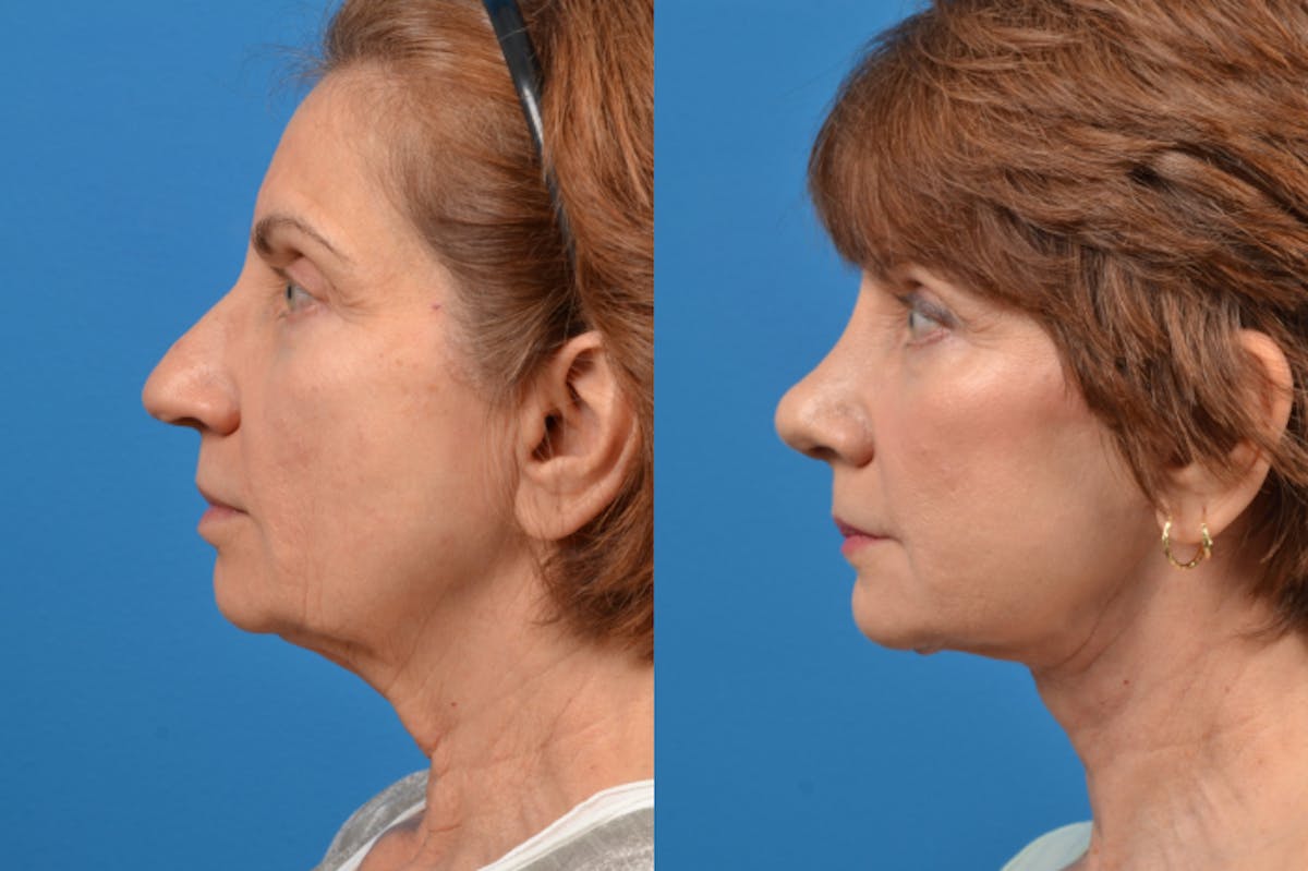 Facelift Before & After Gallery - Patient 122406126 - Image 4