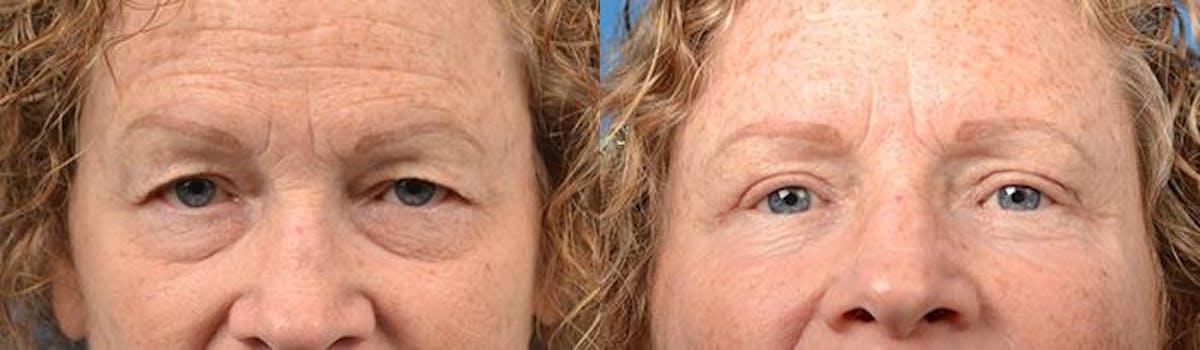 Eyelid Surgery Before & After Gallery - Patient 122406125 - Image 1