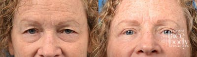 Eyelid Surgery Before & After Gallery - Patient 241451 - Image 1