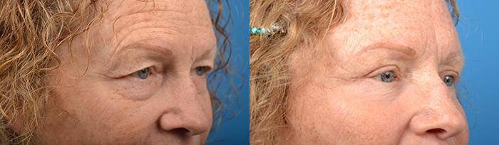 Eyelid Surgery Before & After Gallery - Patient 241451 - Image 2