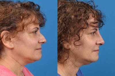 Liquid Rhinoplasty Before & After Gallery - Patient 122406128 - Image 1