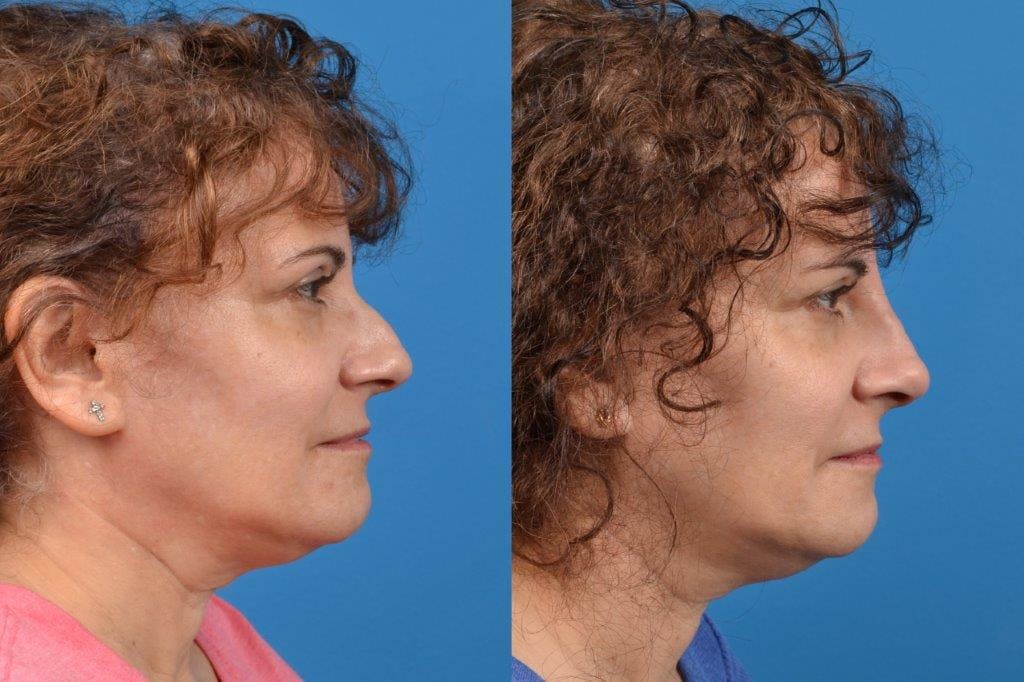 Liquid Rhinoplasty Before & After Gallery - Patient 122406128 - Image 1