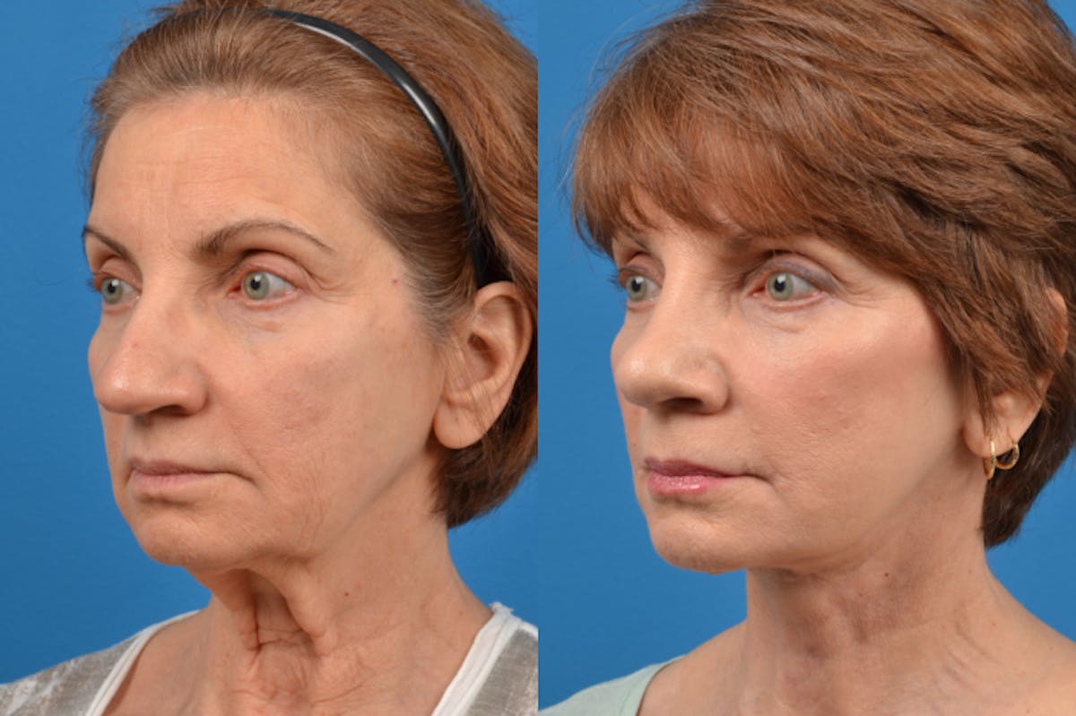 Facelift Before & After Gallery - Patient 122406126 - Image 5