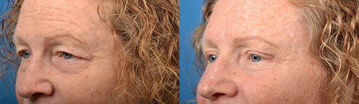 Eyelid Surgery Before & After Gallery - Patient 241451 - Image 3