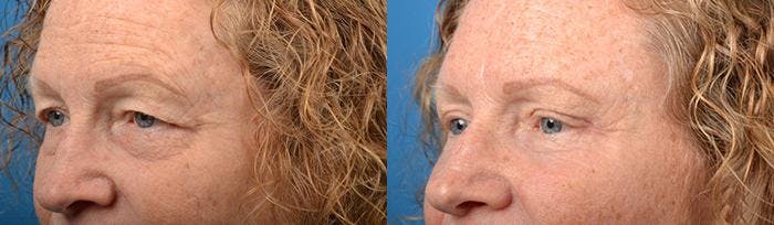 Eyelid Surgery Before & After Gallery - Patient 122406125 - Image 3