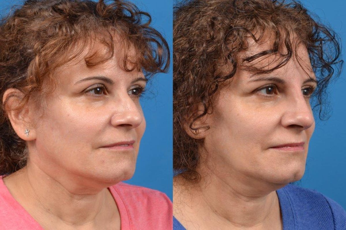 Liquid Rhinoplasty Before & After Gallery - Patient 122406128 - Image 2