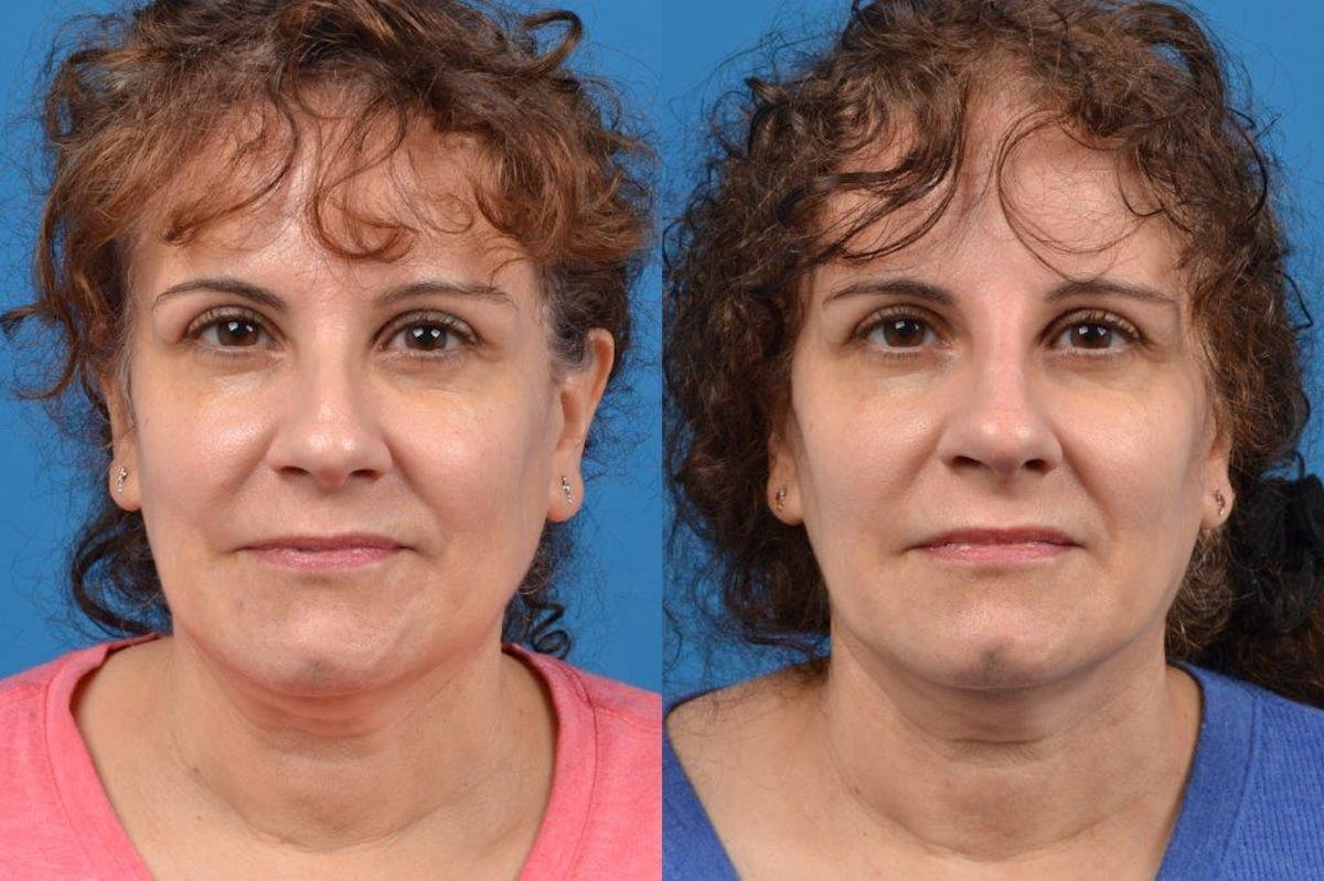 Liquid Rhinoplasty Before & After Gallery - Patient 122406128 - Image 3